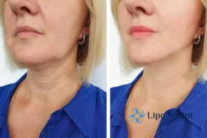 Double chin before and after Hi-Fu treatment 4 Book your double chin treatment Basildon today! We are here to help!