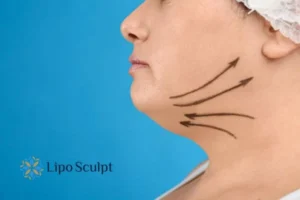 Double chin before and after Hi-Fu treatment 3 Boost your confidence with a Double chin treatment Basildon
