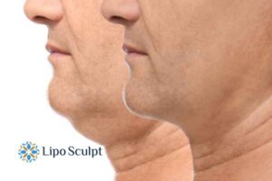 Double chin before and after Hi-Fu treatment 2 Double chin treatment Basildon from Lipo Sculpt - feel more confident today!
