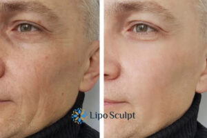 How to Fight Aging Symptoms 3 Fight Aging Symptoms Basildon With HIFU and Morpheus8 Today!