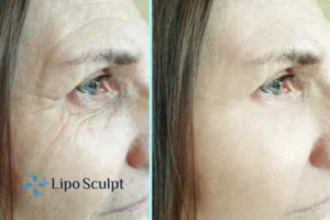 How to Fight Aging Symptoms 2 Do you want to Fight Aging Symptoms Basildon? Contact Lipo Sculpt today!