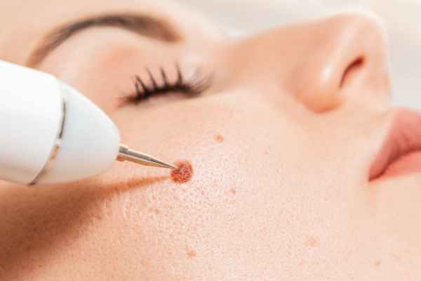 CryoPen: 5 Skin Concerns It May Be Used to Treat 3 What actually happens during a CryoPen treatment Basildon?