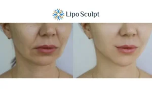 Explaining Total Skin Tightening Treatment And What It Can Do For You 2 Do you want to boost your self confidence? Give Morpheus8 Basildon a try today!