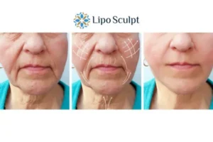 Explaining Total Skin Tightening Treatment And What It Can Do For You 3 Boost your confidence with Morpheus8 Basildon call our team today!