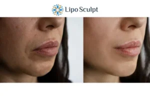 Explaining Total Skin Tightening Treatment And What It Can Do For You 4 Morpheus8 Basildon the best results - call our team today!