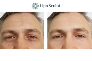 Explaining Total Skin Tightening Treatment And What It Can Do For You 6 Morpheus8 Basildon book in today to find out more!