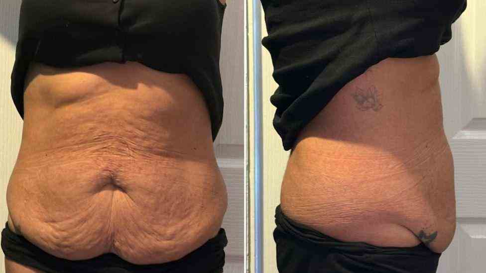 Lost the Weight but Not the Loose Skin? What You Should Know 1 Is It Definitely Loose Skin Basildon?